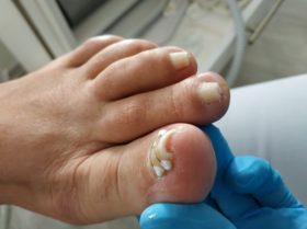 Wkręcające paznokcie w trakcie leczenia w gabinecie podologicznym w Kielcach