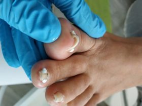 Leczenie wkręcających paznokci w Gabinecie Zdrowych Stóp