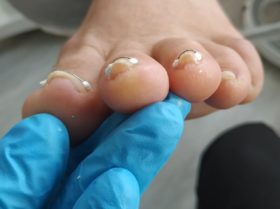 Monika Cichoń kontroluje wkręcające paznokcie pacjentki