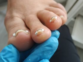 Klamry prostujące płytkę paznokcia nałożone na wkręcające paznokcie