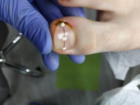 Proces naprawy wrastających paznokci w gabinecie podologicznym
